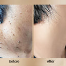 Scar Remove™ Removedor de Cicatrizes e Marcas de Expressão