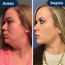 FaceLift™ Redutor de Rugas e Papada - Tenha um rosto LINDO novamente sem Papadas + Creme Exclusivo de Brinde